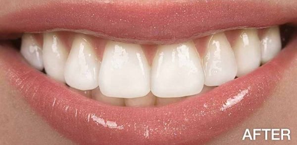 Teeth Whitening — after treatment