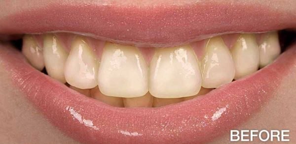 Teeth Whitening — before treatment